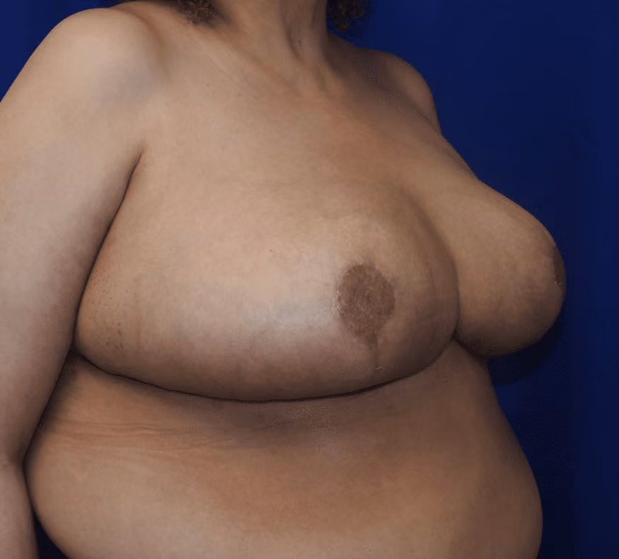 Breast Reduction before and after, case 878 - Cool Springs Plastic Surgery