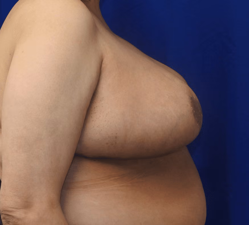 Breast Reduction before and after, case 878 - Cool Springs Plastic Surgery
