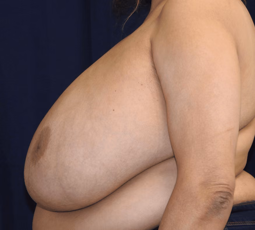 Breast Reduction before and after, case 878 - Cool Springs Plastic Surgery