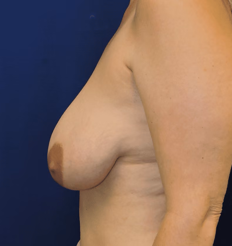Breast Lift before and after, case 859 - Cool Springs Plastic Surgery