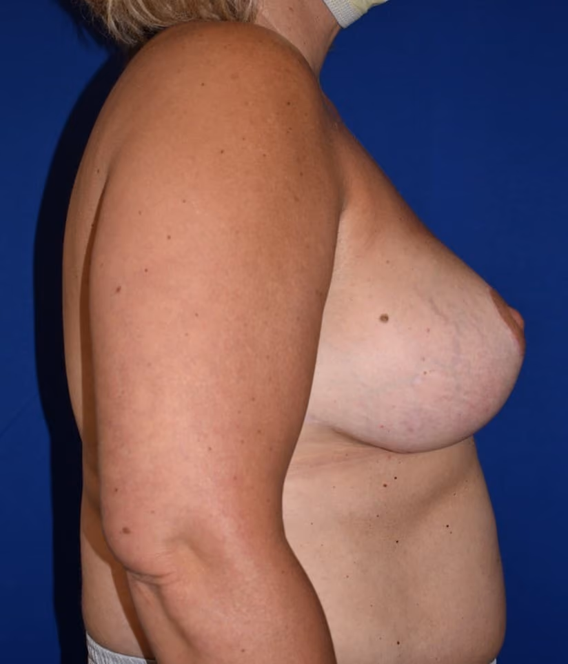 Breast Lift before and after, case 848 - Cool Springs Plastic Surgery