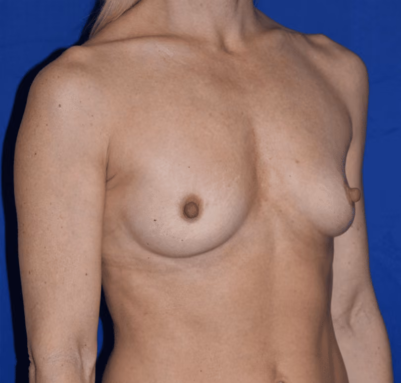 Breast Augmentation before and after, case 820 - Cool Springs Plastic Surgery