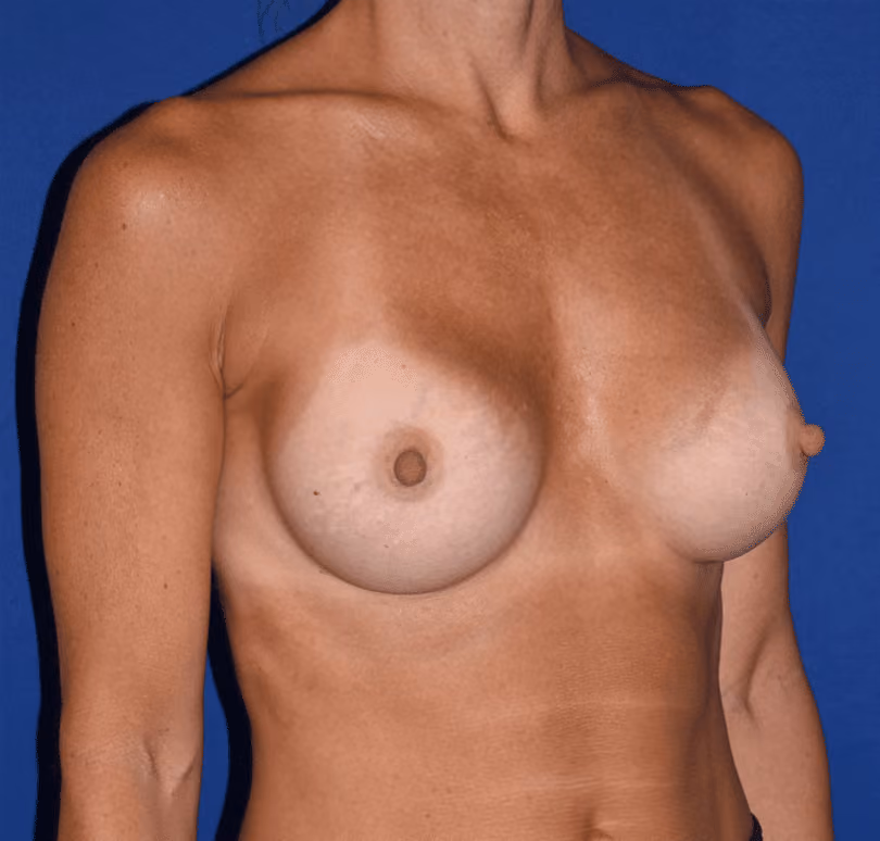 Breast Augmentation before and after, case 820 - Cool Springs Plastic Surgery