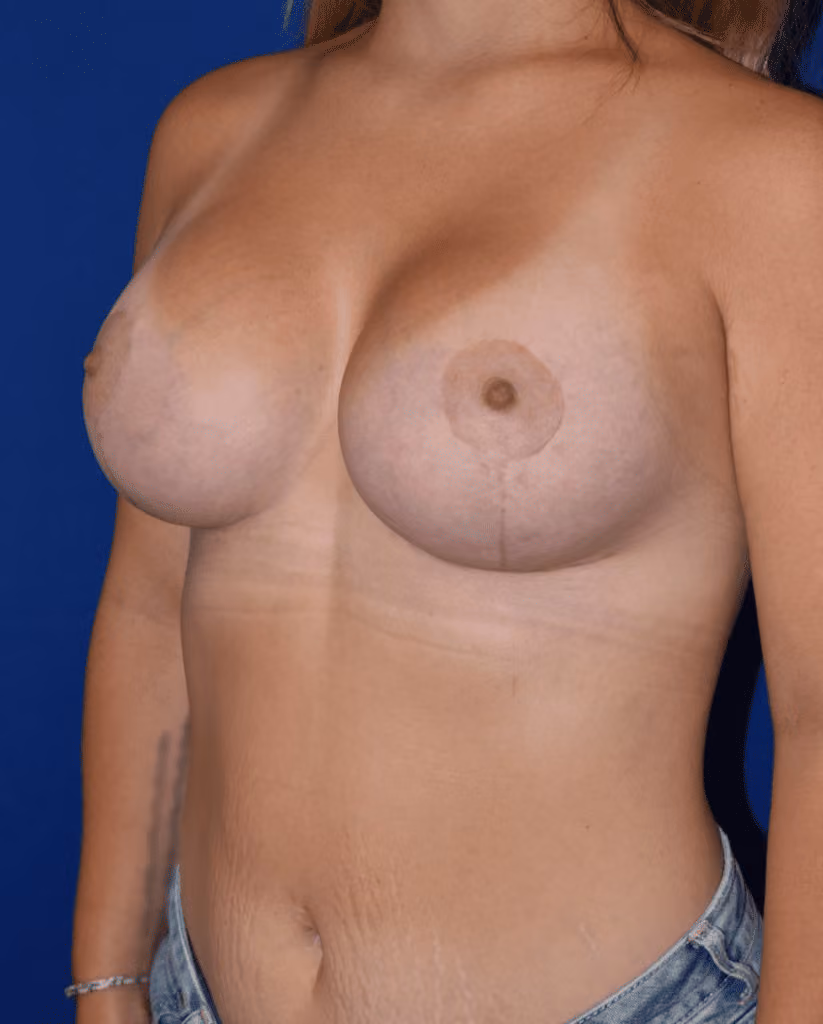 Breast Lift + Augmentation before and after, case 795 - Cool Springs Plastic Surgery