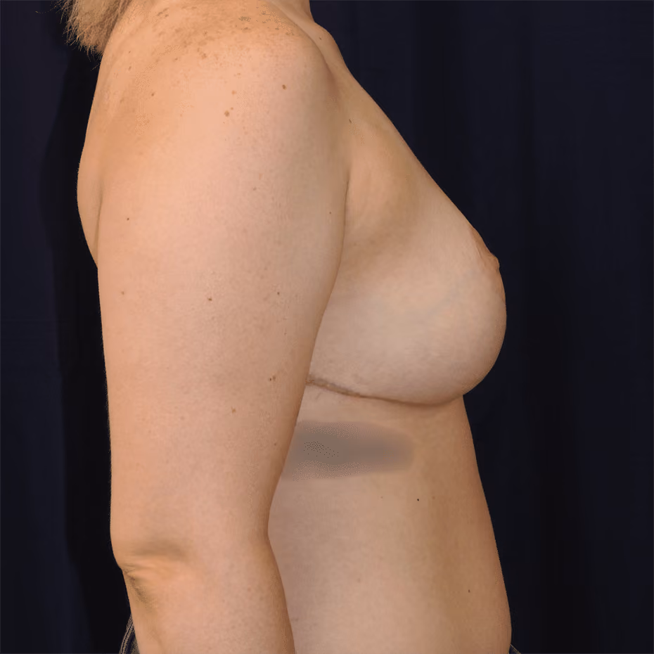 Breast Reduction before and after, case 772 - Cool Springs Plastic Surgery