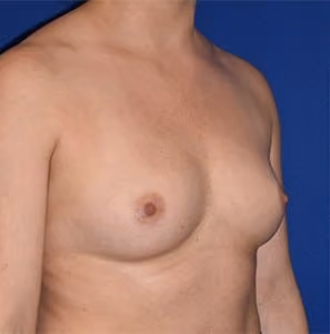 Breast Augmentation before and after, case 727 - Cool Springs Plastic Surgery