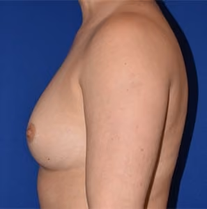 Breast Augmentation before and after, case 727 - Cool Springs Plastic Surgery