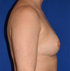 Breast Augmentation before and after, case 727 - Cool Springs Plastic Surgery