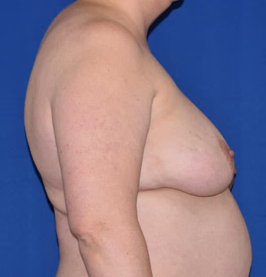 Breast Lift + Augmentation before and after, case 660 - Cool Springs Plastic Surgery