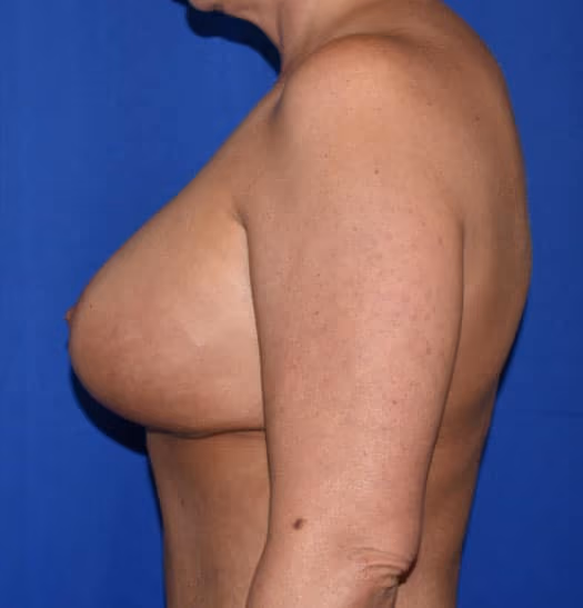 Breast Lift + Augmentation before and after, case 660 - Cool Springs Plastic Surgery
