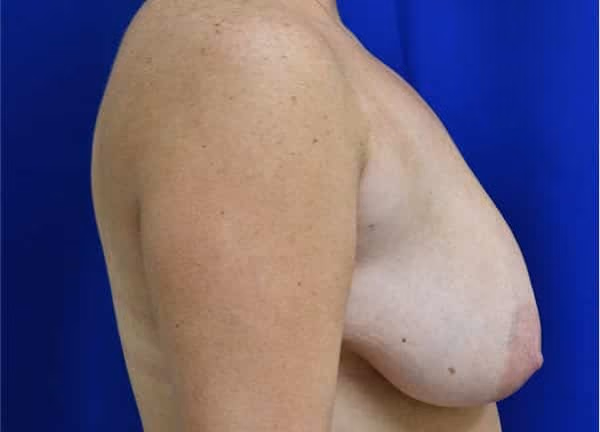 Breast Lift + Augmentation before and after, case 626 - Cool Springs Plastic Surgery