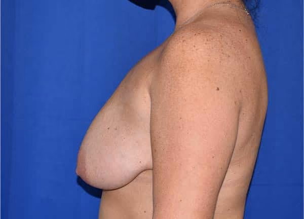 Breast Lift + Augmentation before and after, case 626 - Cool Springs Plastic Surgery