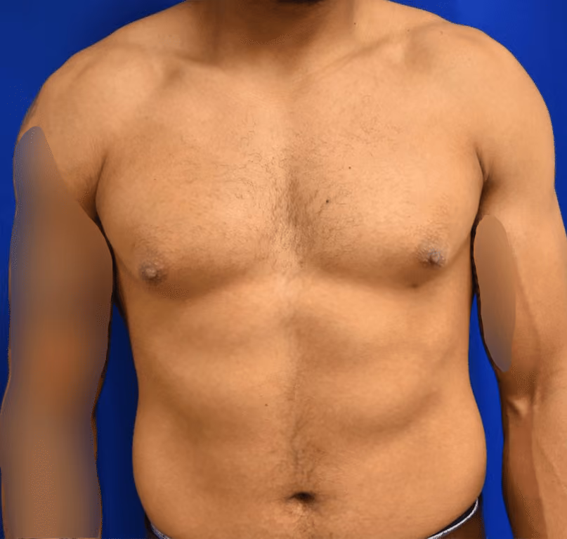 Gynecomastia before and after, case 590 - Cool Springs Plastic Surgery