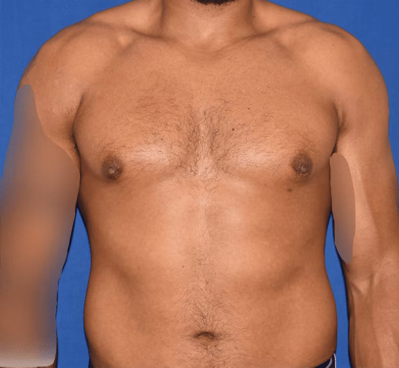 Gynecomastia before and after, case 590 - Cool Springs Plastic Surgery