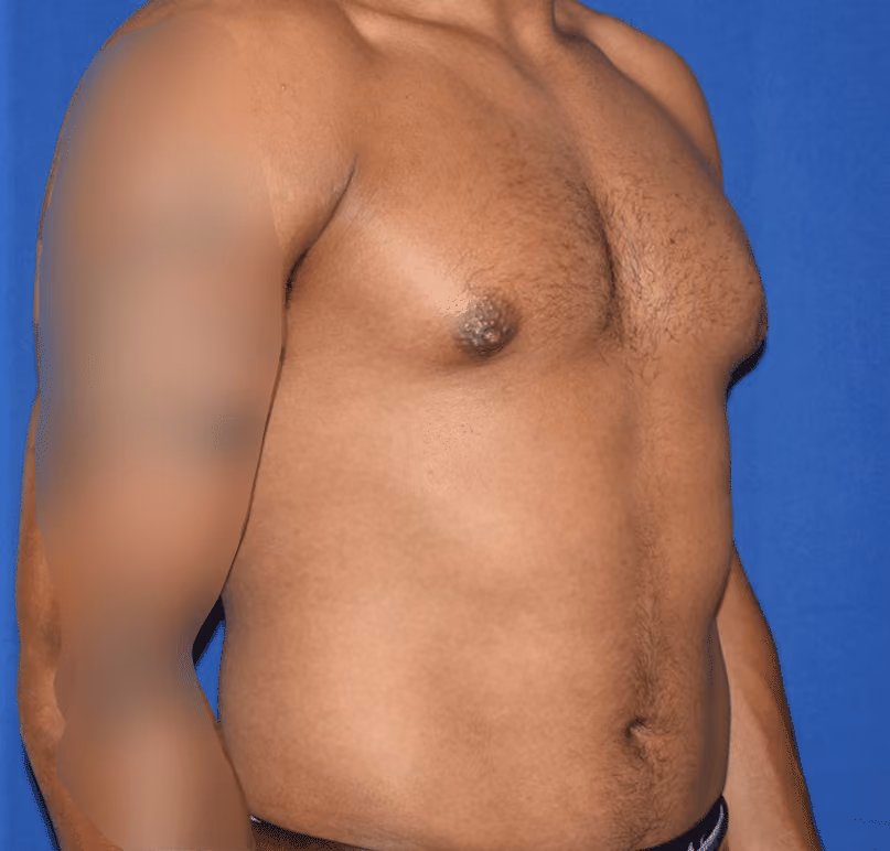 Gynecomastia before and after, case 590 - Cool Springs Plastic Surgery