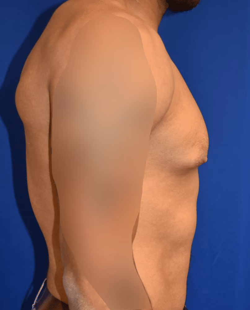 Gynecomastia before and after, case 590 - Cool Springs Plastic Surgery