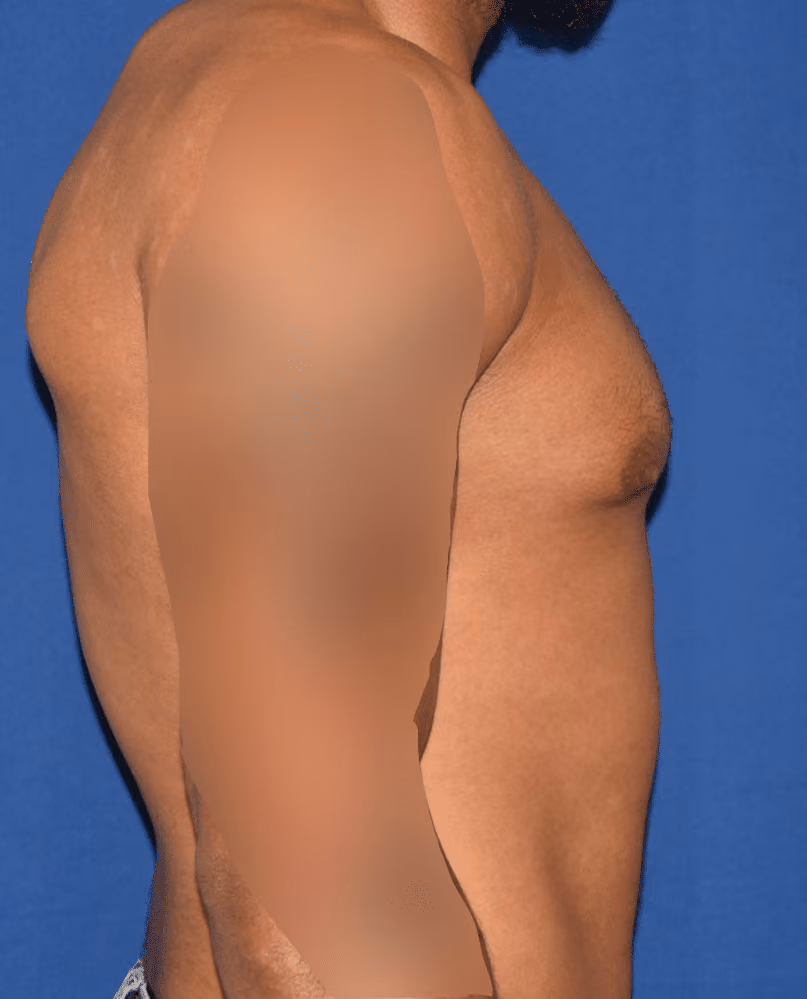 Gynecomastia before and after, case 590 - Cool Springs Plastic Surgery