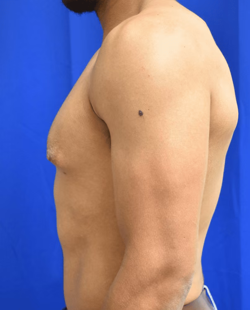 Gynecomastia before and after, case 590 - Cool Springs Plastic Surgery
