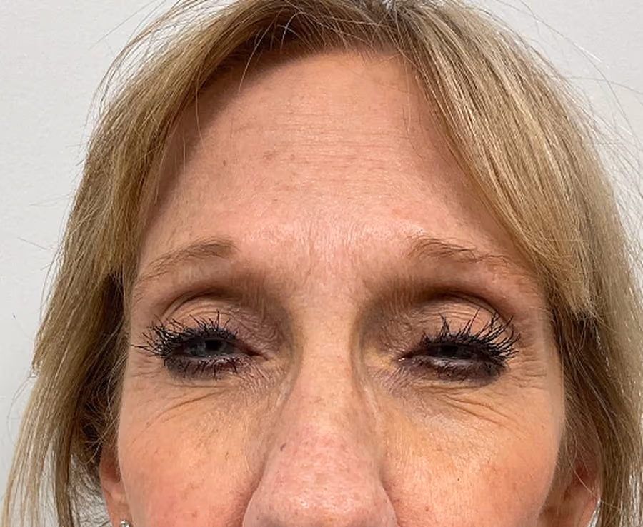Botox before photo, glabella frown lines — Chrissy Handly, Case 65, Cool Springs Plastic Surgery, Brentwood TN