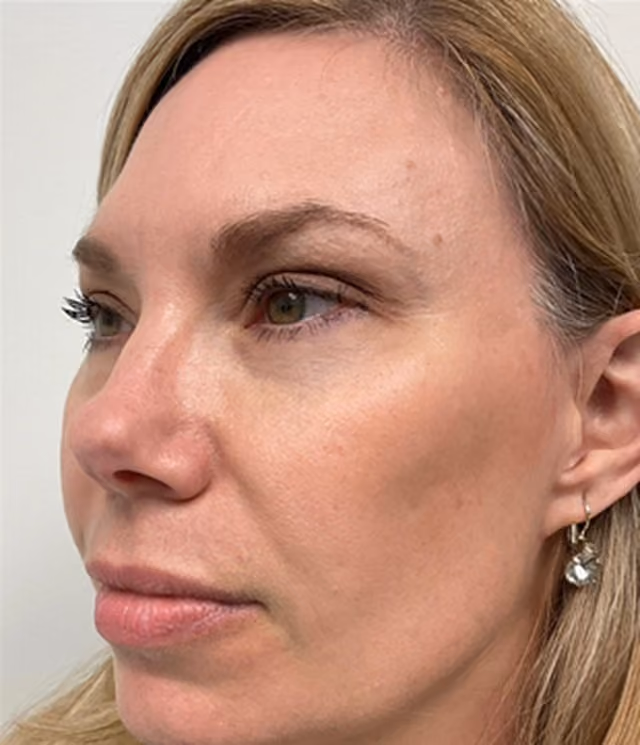 Midface filler before photo — Chrissy Handly, Case 73, Cool Springs Plastic Surgery, Brentwood TN