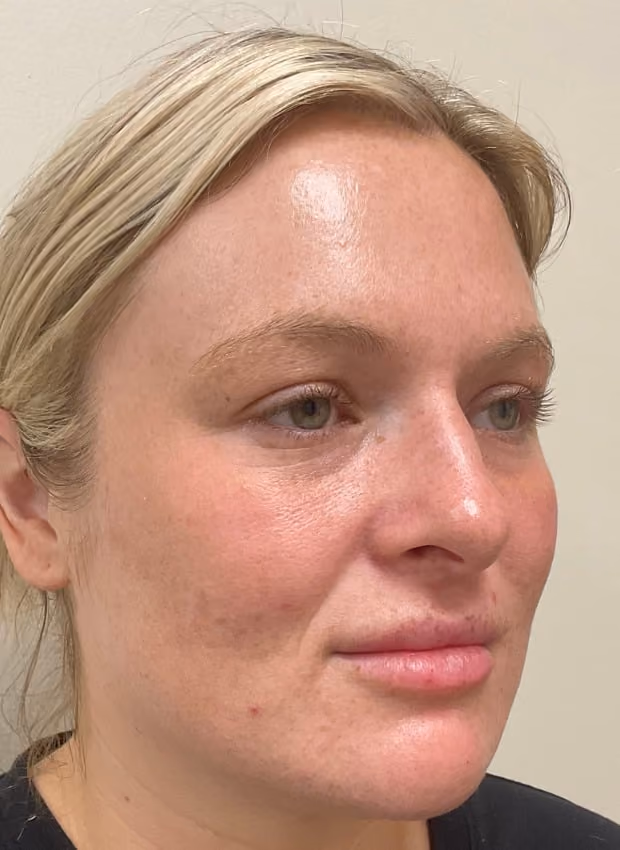 Laser skin treatment after photo — Natalie Moros, Case 100, Cool Springs Plastic Surgery, Brentwood TN
