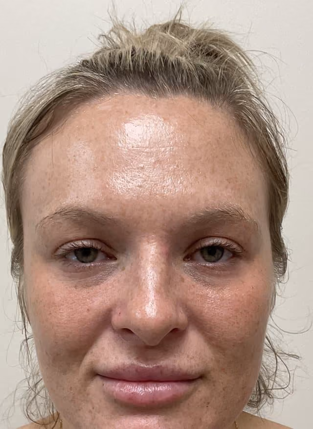 Laser skin treatment before photo — Natalie Moros, Case 100, Cool Springs Plastic Surgery, Brentwood TN