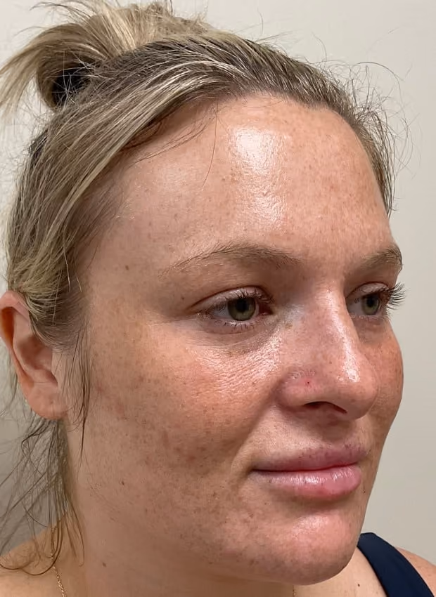 Laser skin treatment before photo — Natalie Moros, Case 100, Cool Springs Plastic Surgery, Brentwood TN