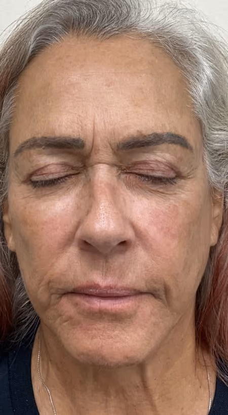 Laser skin treatment before photo — Destiny Berger, Case 111, Cool Springs Plastic Surgery, Brentwood TN