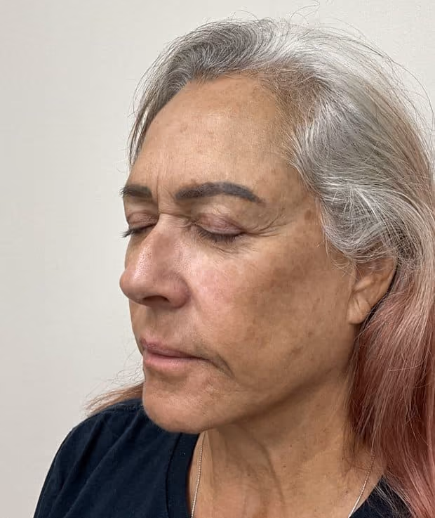 Laser skin treatment before photo — Destiny Berger, Case 111, Cool Springs Plastic Surgery, Brentwood TN