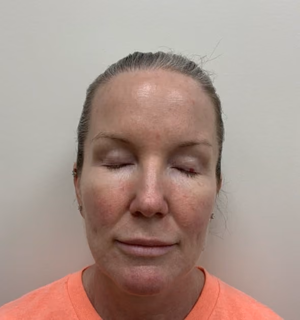 Laser skin treatment before photo — Destiny Berger, Case 97, Cool Springs Plastic Surgery, Brentwood TN