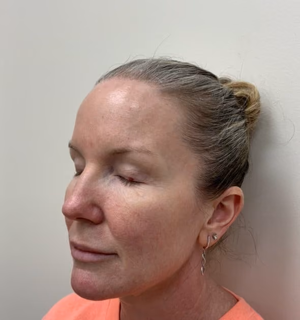 Laser skin treatment before photo — Destiny Berger, Case 97, Cool Springs Plastic Surgery, Brentwood TN