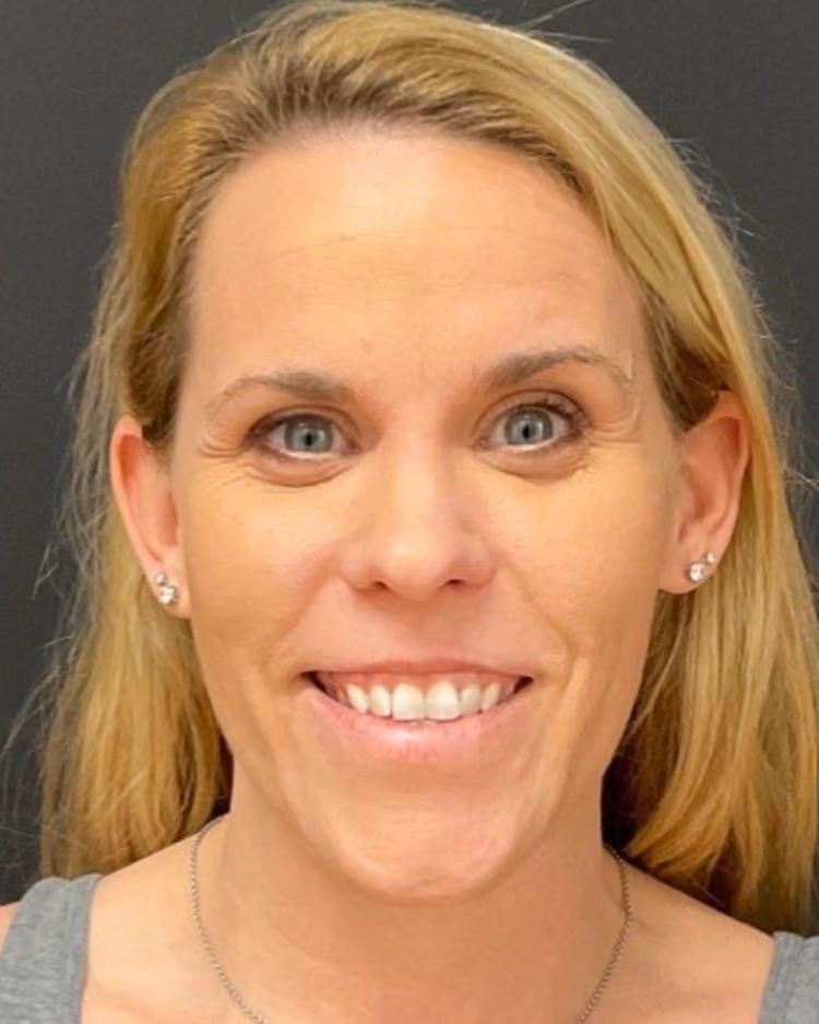 Botox before photo of CSPS patient — forehead and glabella lines — Brentwood TN