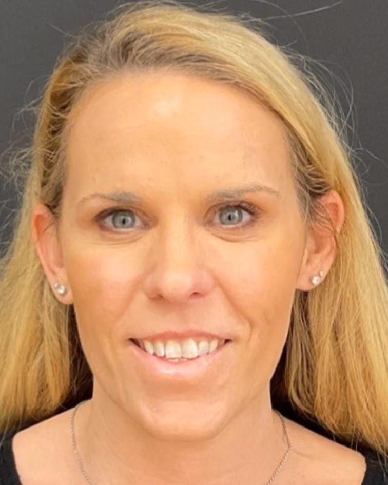 Botox after photo of CSPS patient — smoother forehead and glabella — Brentwood TN