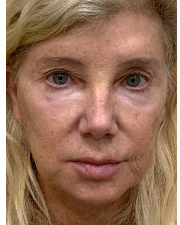 Before Halo and BBL laser treatment for skin discoloration and uneven tone at Cool Springs Plastic Surgery in Nashville