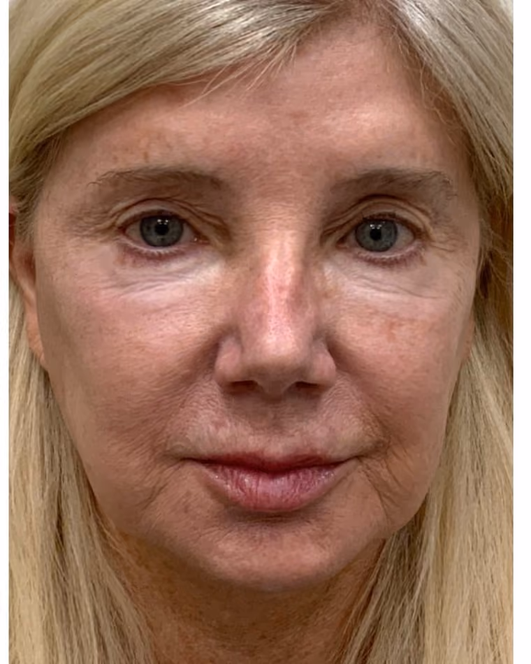 After Halo and BBL laser treatment showing more even skin tone and reduced discoloration at Cool Springs Plastic Surgery in Nashville