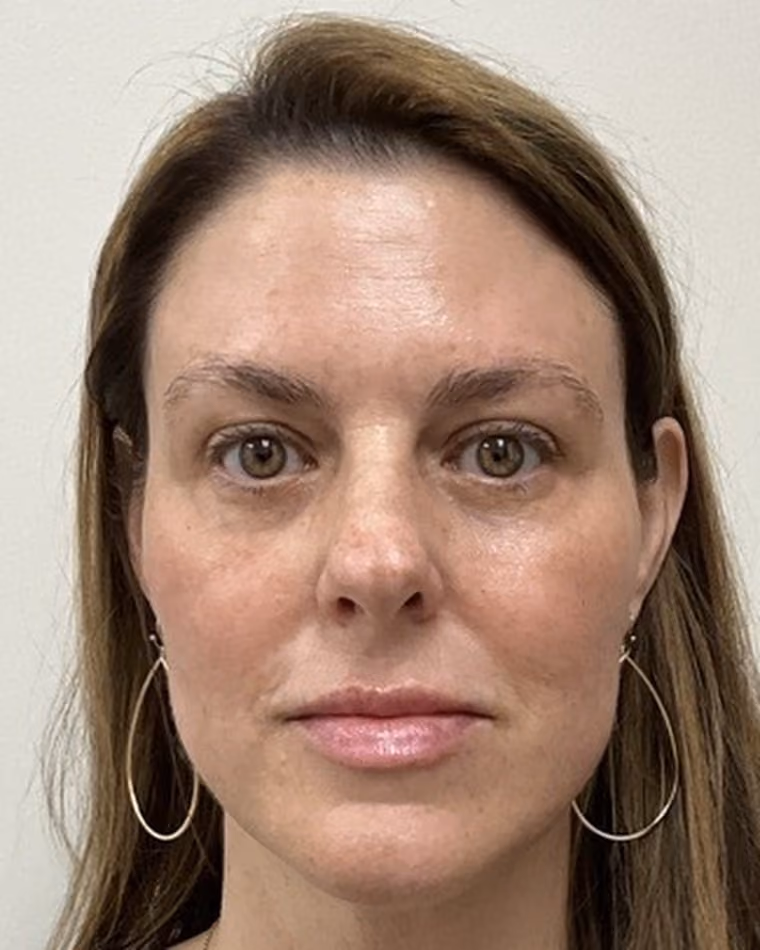 After Halo + BBL laser, under-eye PDGF, and lip and cheek filler with Kaitlyn Jones, PA-C at Cool Springs Plastic Surgery — front view showing clearer, more even skin