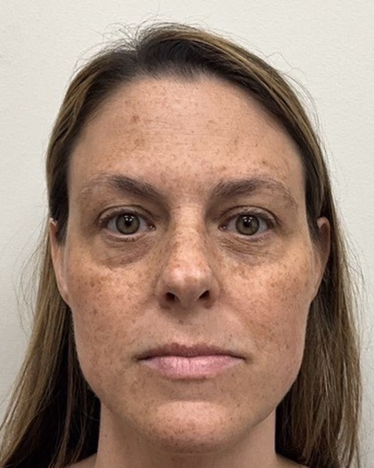 Before Halo + BBL laser, under-eye PDGF, and lip and cheek filler with Kaitlyn Jones, PA-C at Cool Springs Plastic Surgery — front view showing facial pigment and sun damage