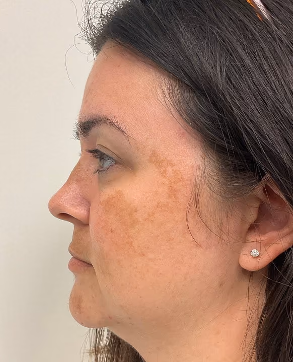 Medical-grade skincare before photo, melasma — Chrissy Handly, Case 61, Cool Springs Plastic Surgery, Brentwood TN