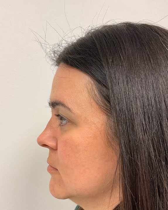 Medical-grade skincare before photo, melasma — Chrissy Handly, Case 61, Cool Springs Plastic Surgery, Brentwood TN