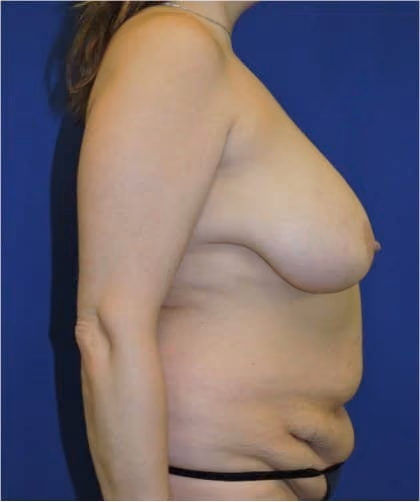Breast Lift before and after, case 1078 - Cool Springs Plastic Surgery