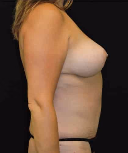 Breast Lift before and after, case 1078 - Cool Springs Plastic Surgery
