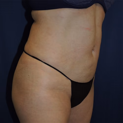 Liposuction before and after, case 7527 - Cool Springs Plastic Surgery
