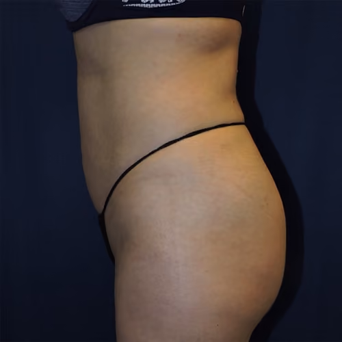 Liposuction before and after, case 7527 - Cool Springs Plastic Surgery