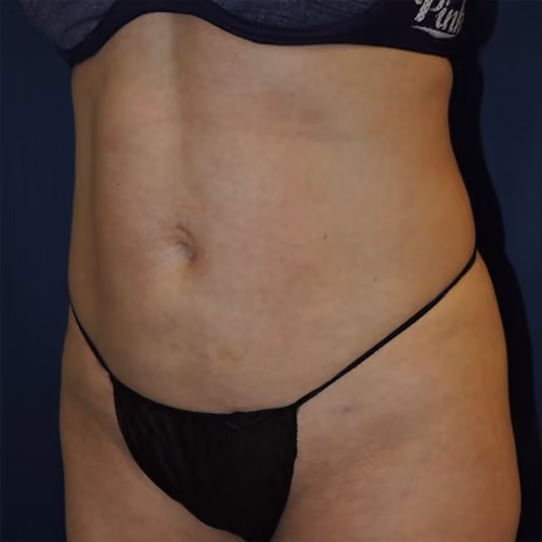 Liposuction before and after, case 7527 - Cool Springs Plastic Surgery
