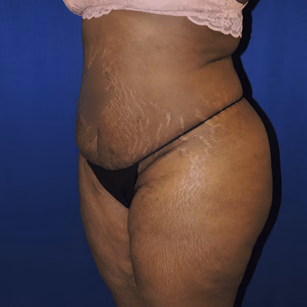 Brazilian Butt Lift before and after, case 7078 - Cool Springs Plastic Surgery
