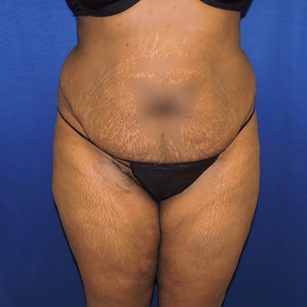 Brazilian Butt Lift before and after, case 7078 - Cool Springs Plastic Surgery