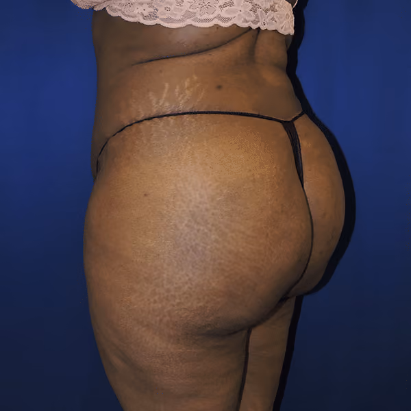 Brazilian Butt Lift before and after, case 7078 - Cool Springs Plastic Surgery