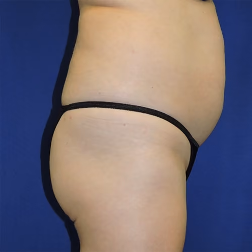 Liposuction before and after, case 7527 - Cool Springs Plastic Surgery