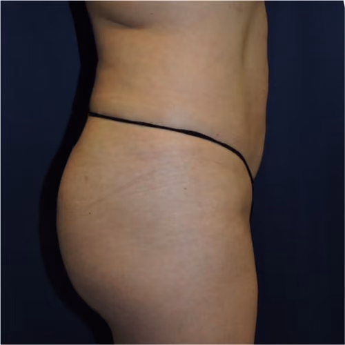 Liposuction before and after, case 7527 - Cool Springs Plastic Surgery