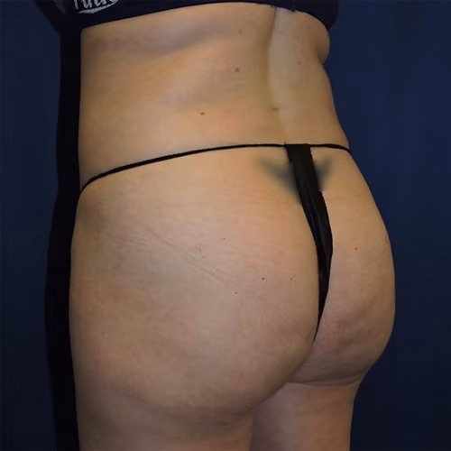 Liposuction before and after, case 7527 - Cool Springs Plastic Surgery